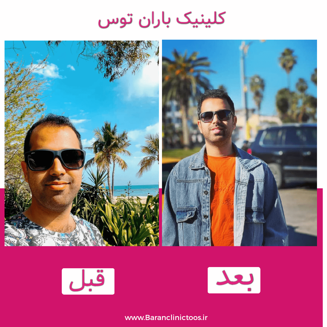 قبل و بعد کاشت مو